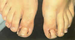 Ingrown toenails - Click to enlarge